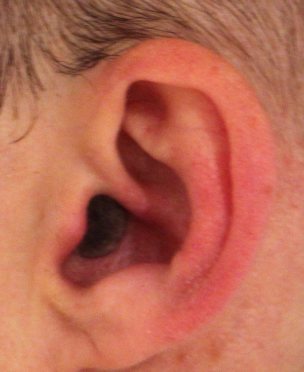 invisible earplug: cut and painted foam earplug and extra deep inserted